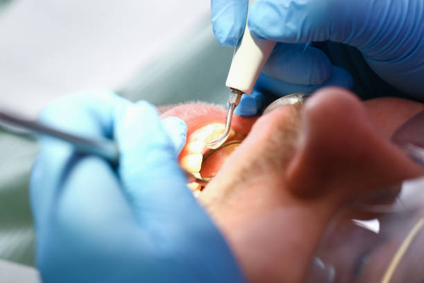 Best Emergency Dentist for Knocked-Out Tooth in Crawford, GA